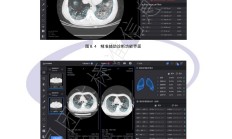 医疗影像分析的AI应用